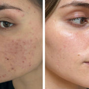 Acne Infusion 8 weken plan