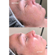 Renewal Infusion 1 single applicatie