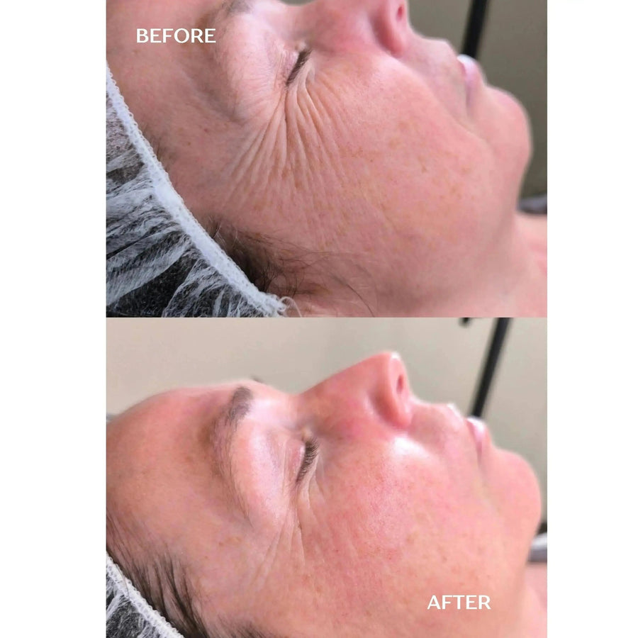 Renewal Infusion 1 single applicatie